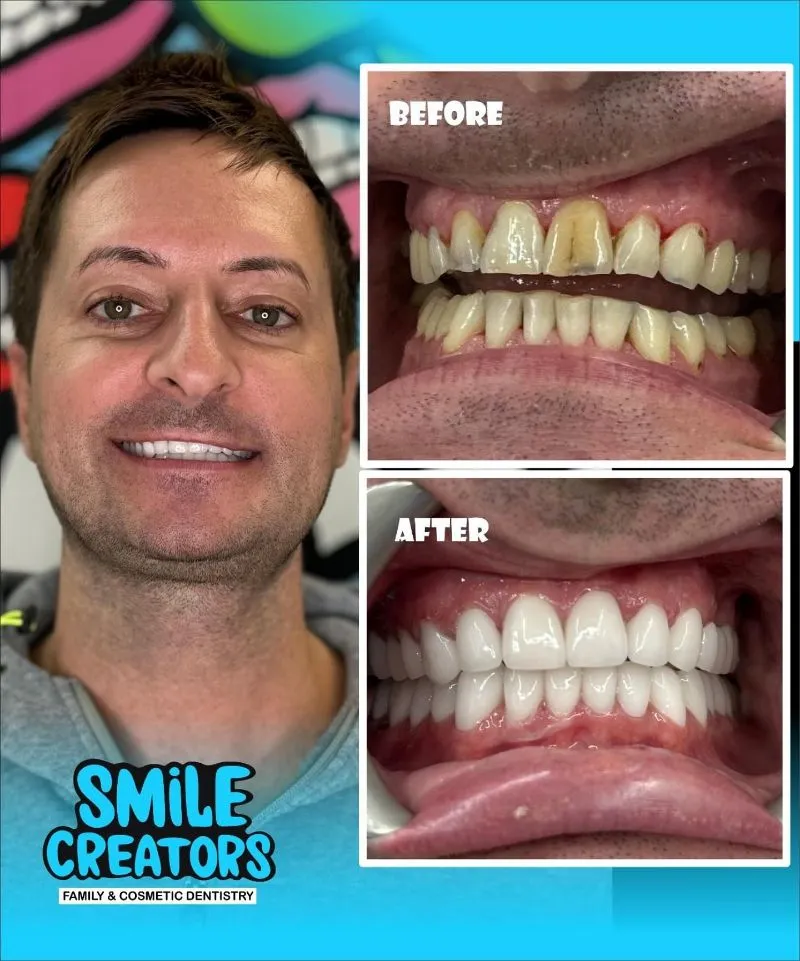 A before and after photo of a man 's teeth from smile creators