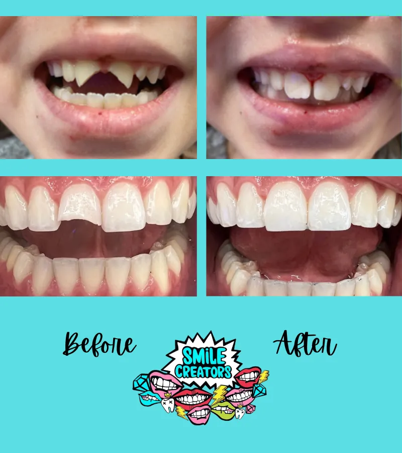 A before and after picture of a person 's teeth
