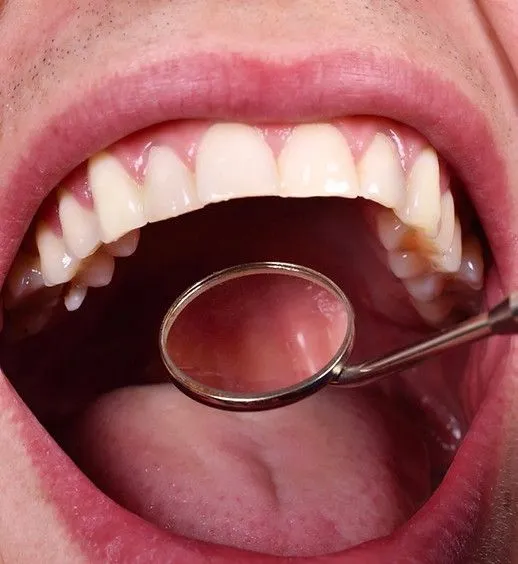 A man is getting his teeth examined with a dental mirror